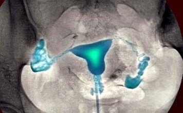Что такое гистеросальпингография и когда она проводится?