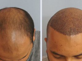 Пересадка волос методом FUE