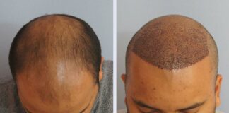 Пересадка волос методом FUE