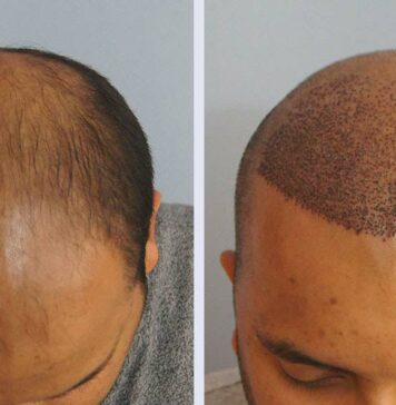 Пересадка волос методом FUE