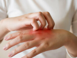 В чем отличие экземы от дерматита?