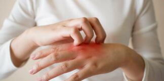 В чем отличие экземы от дерматита?